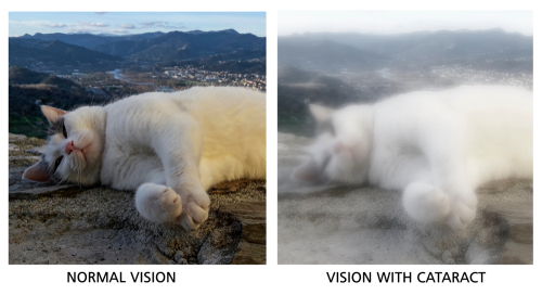 Comparison of normal vision vs vision with cataract showing faded colors