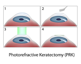 Photorefractive keratectomy (PRK) procedure diagram: laser vision correction steps
