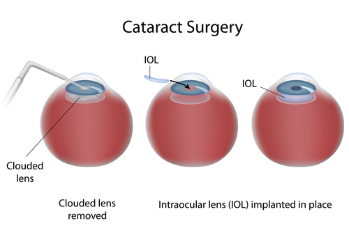Senior man rubbing eyes tiredly, experiencing daily vision strain from cataracts