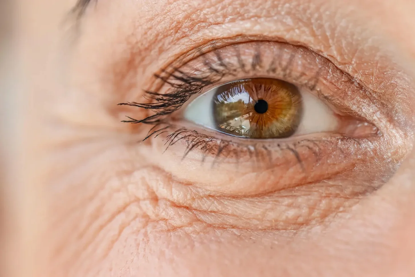 Close-up of a woman’s eye, showing cataract condition and the need for cataract eye surgery.