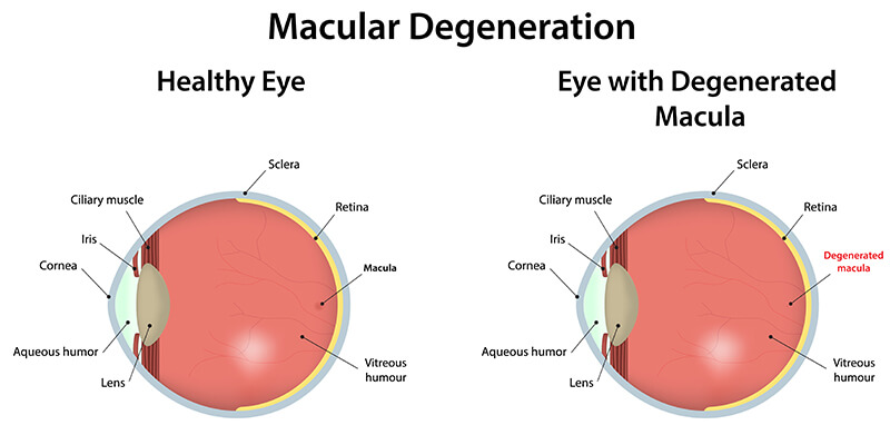 Diagram showing a healthy eye and eye with degenerated macula.