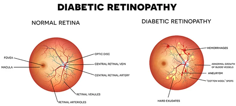 Diagram showing a normal retina and an eye with diabetic retinopathy.