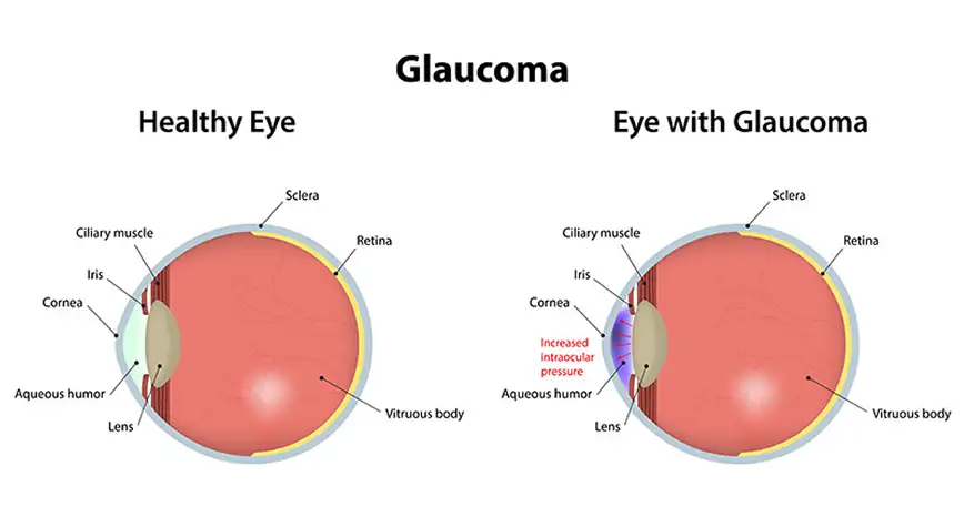 Eye diagram showing glaucoma.